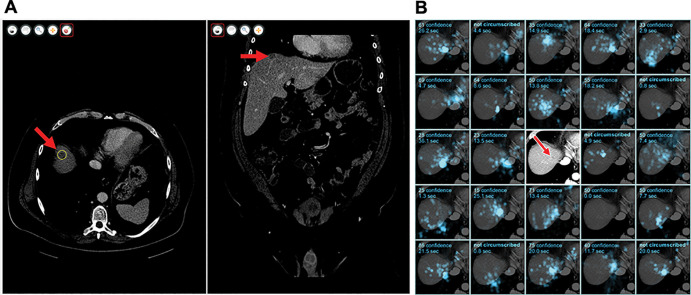 (A) Graphic user interface of the workstation software. A metastasis (arrow) has been circumscribed in the axial stack (left) using liver window settings and can also be seen in the coronal stack (right). (B) Eye-tracking data for an example metastasis for 24 of the 25 readers. Each of the 24 subpanels shows gaze in a cyan overlay for a reader, the confidence score of the circumscription or a comment that the metastasis was not circumscribed, and the duration of gaze near the metastasis. Five of 24 readers did not circumscribe this metastasis, including one who gazed at this metastasis for 20 seconds. The central subpanel was replaced to show the metastasis itself (arrow) without the overlay.