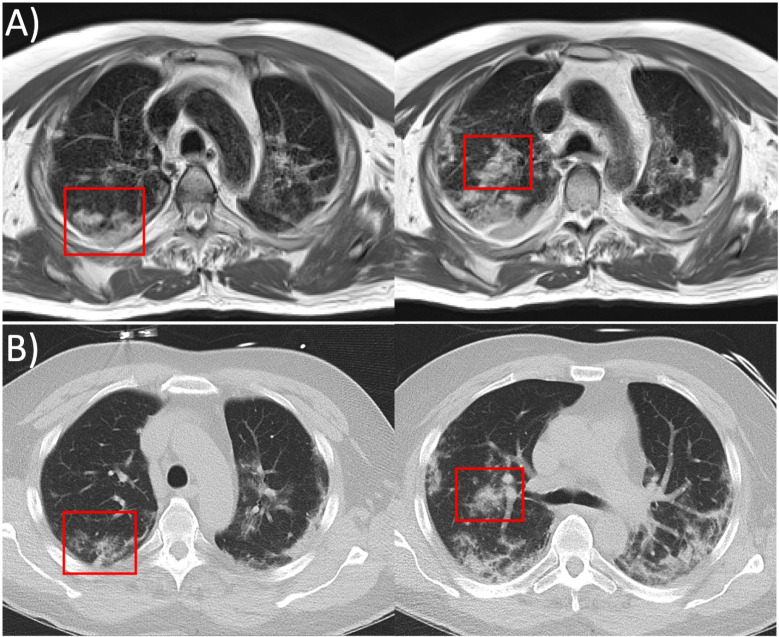 Two axial slices from, A, 0.55T MRI (prototype MAGNETOM Aera, Siemens Healthineers, Erlangen, Germany) with spatial resolution 1.2mm x 1.2mm x 6mm (respiratory gated fast-BLADE turbo spin echo acquisition, TE/TR= 48ms/3471ms respiratory interval, acquisition time = 5min 15s) and, B, CT (SOMATOM Force, Siemens Healthcare, Erlangen, Germany) reformatted to 0.6mm x 0.6mm x 6mm spatial resolution. Multifocal lesions equivalent to ground glass opacities on CT and peripheral distribution of consolidative opacities characteristic of COVID-19 are observed using both imaging modalities. In some regions, the severity of the abnormality appears worse on MRI, as shown in the red boxes.