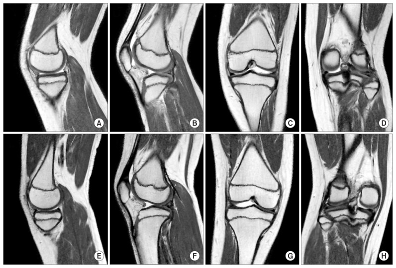 Bilateral Hypoplasia Of The Medial And Lateral Menisci - Pmc