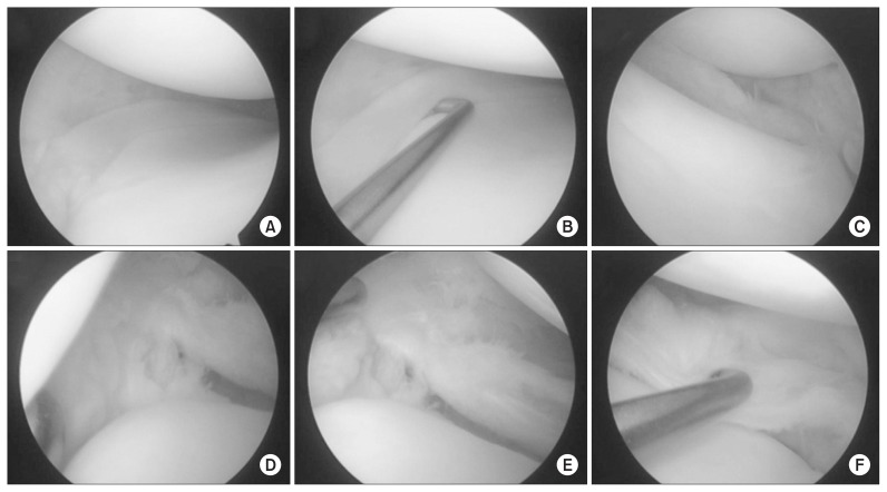 Bilateral Hypoplasia Of The Medial And Lateral Menisci - Pmc