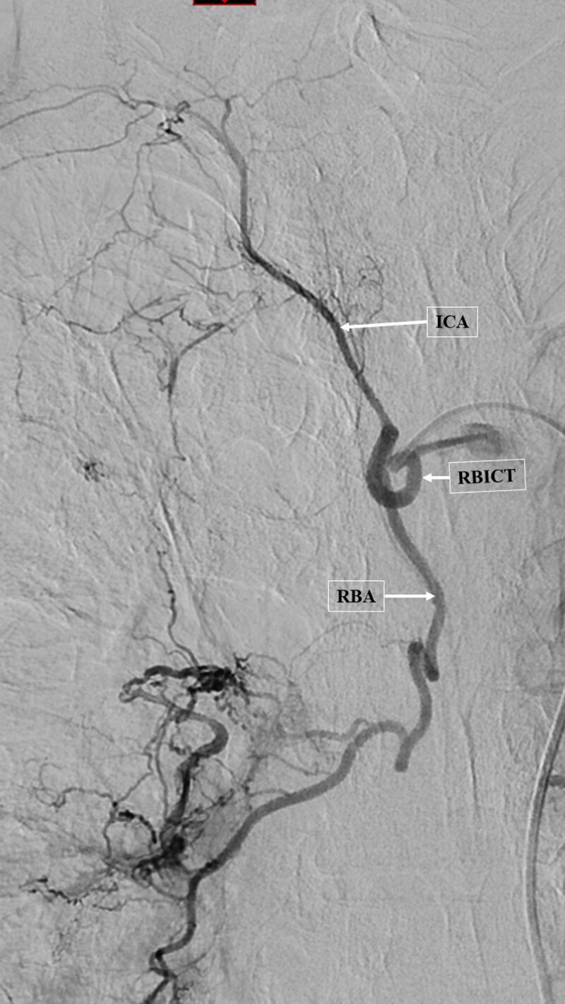 Enlarged right broncho-intercostal trunk with systemic-pulmonary shunt