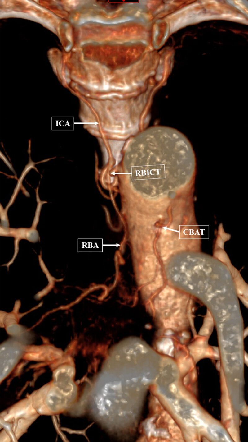 VRT of an enlarged right bronchial intercostal trunk