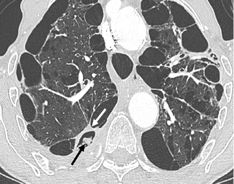 Chronic cavitary aspergillosis within emphysema bulla with endovascular material