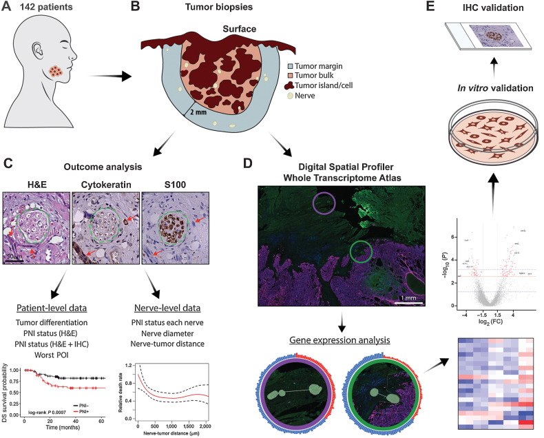 Figure 1. Schematic summary of study design. A, Cohort of 142 patients with OSCC. B, Tumor biopsy samples were serially sectioned. All nerves in the tumor bulk and in a 2 mm margin around the tumor bulk were assessed. C, H&E, cytokeratin, and S100 stains were used to locate tumor cells and nerves. Green dashed lines show the nerve outline and red arrows indicate tumor cells. Scale bar, 50 μm. Analysis of serial sections generated patient-level and nerve-level data, used for outcome analysis. D, A subset of samples (n = 8) was selected for spatial transcriptomic analysis. Morphology markers for cytokeratin and S100 were used to guide identification of nerve areas in relation to tumor. AOIs for a nerve close to tumor (green circle) and a nerve far from tumor (purple circle) are overlaid in the immunofluorescence image and enlarged below. Tissues were probed for over 18,000 genes; differential gene expression analysis was performed comparing nerves in different areas of the tumor specimen. E, In vitro validation was performed in neuronal and Schwann cells, and rat DRG; IHC validation was performed in patient tissue specimens.