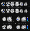 Brain MRI scans show functional connectivity comparisons in different regions: panels A and B depict left supplementary motor area analysis between BOM vs HC; panels C and E illustrate right pallidum analysis for BOM vs HC; panels D and F show right pallidum comparison for BOM vs BSP. Blue color indicates significant areas of interest at various Z and X coordinates, with color scales denoting statistical values.