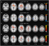 Four rows of brain imaging results comparing sALFF and dALFF in two conditions: BSP vs HC and BOM vs HC. Rows A and B depict sALFF results with highlighted areas in orange, red, and blue. Rows C and D show dALFF results with significant activation in red. A color bar on the right indicates statistical values. Images are labeled with slice positions (Z-coordinates) and lateral orientations.