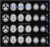 Brain MRI images comparing different functional connectivity strengths. Panel A shows static functional connectivity (sFC) BOM vs HC with highlighted blue areas. Panel B displays sFC BOM vs BSP. Panel C presents dynamic functional connectivity (dFC) strength BOM vs HC. Panel D shows dFC strength BOM vs BSP. Color bars indicate significance levels ranging from -3 to approximately -6.73, with specific Z-slice levels noted.