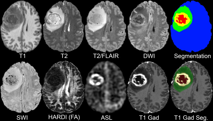 Representative multimodal MRI studies in a 37-year-old man with glioblastoma in the University of California San Francisco Preoperative Diffuse Glioma MRI dataset. ASL = arterial spin labeling perfusion, DWI = isotropic (trace) diffusion-weighted imaging, HARDI (FA) = fractional anisotropy derived from high-angular-resolution diffusion imaging data, Segmentation = multicompartment tumor segmentation (blue = brain, green = fluid-attenuated inversion recovery [FLAIR] abnormality, yellow = enhancing tumor, red = necrotic core), SWI = susceptibility-weighted imaging, T1 = T1-weighted precontrast, T1 Gad = T1-weighted postgadolinium, T1 Gad Seg. = tumor segmentation semitransparent overlay on T1-weighted postgadolinium image, T2 = T2-weighted, T2/FLAIR = T2-weighted FLAIR.