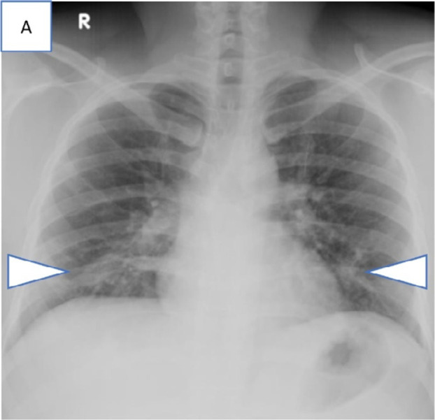 Series of chest radiograph in patients with COVID-19 pneumonia who were clinically asymptomatic and transferred out of the community care facility, Singapore Expo, to acute hospitals in view of findings of pulmonary infection on chest radiographs. Admission chest radiographs, A, in 36-year-old man on day 6 of illness showing bilateral lower zone patchy GGOs suspicious for infective foci (arrowheads), B, in 28-year-old man on day 2 of illness showing extensive consolidation (arrowheads) in the right mid and lower zone, and, C, in 55-year-old man on day 24 of illness with consolidation in the right upper zone (arrowhead).