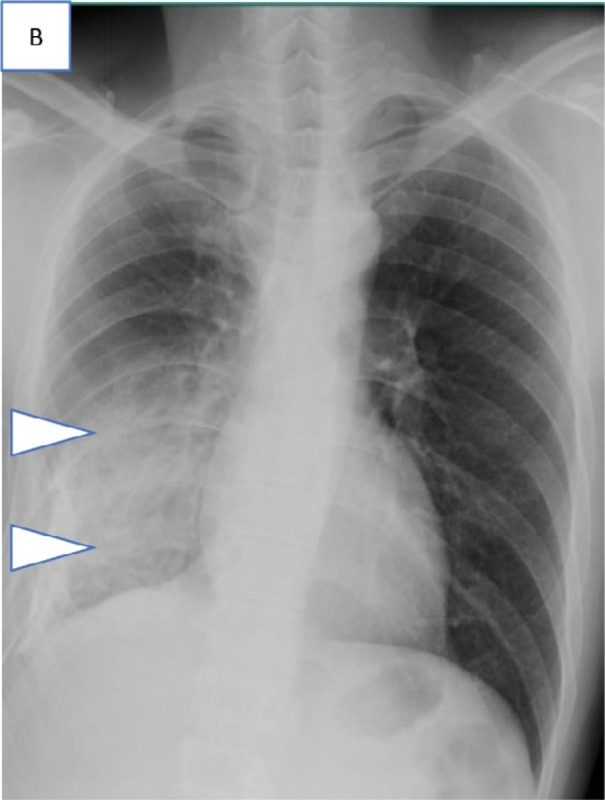 Series of chest radiograph in patients with COVID-19 pneumonia who were clinically asymptomatic and transferred out of the community care facility, Singapore Expo, to acute hospitals in view of findings of pulmonary infection on chest radiographs. Admission chest radiographs, A, in 36-year-old man on day 6 of illness showing bilateral lower zone patchy GGOs suspicious for infective foci (arrowheads), B, in 28-year-old man on day 2 of illness showing extensive consolidation (arrowheads) in the right mid and lower zone, and, C, in 55-year-old man on day 24 of illness with consolidation in the right upper zone (arrowhead).