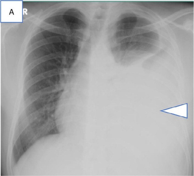 Series of chest radiograph in patients with COVID-19 pneumonia who were transferred out of community care facility, Singapore Expo, to acute hospitals in view of respiratory symptoms or deranged vitals and subsequently required supplemental oxygen. Admission chest radiographs, A, in a 41-year-old man on day 3 of illness with a large left pleural effusion and adjacent consolidation (arrowhead) treated for concomitant pleural tuberculosis, B, in a 40-year-old man on day 4 of illness with consolidation across the left mid and upper zones (arrowheads), and, C, in a 42-year-old man on day 4 of illness with patchy GGOs in the peripheral aspects of both the mid zone and the left lower zone (arrowheads).