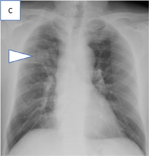 Series of chest radiograph in patients with COVID-19 pneumonia who were clinically asymptomatic and transferred out of the community care facility, Singapore Expo, to acute hospitals in view of findings of pulmonary infection on chest radiographs. Admission chest radiographs, A, in 36-year-old man on day 6 of illness showing bilateral lower zone patchy GGOs suspicious for infective foci (arrowheads), B, in 28-year-old man on day 2 of illness showing extensive consolidation (arrowheads) in the right mid and lower zone, and, C, in 55-year-old man on day 24 of illness with consolidation in the right upper zone (arrowhead).