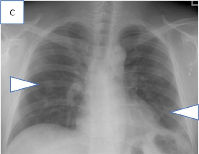 Series of chest radiograph in patients with COVID-19 pneumonia who were transferred out of community care facility, Singapore Expo, to acute hospitals in view of respiratory symptoms or deranged vitals and subsequently required supplemental oxygen. Admission chest radiographs, A, in a 41-year-old man on day 3 of illness with a large left pleural effusion and adjacent consolidation (arrowhead) treated for concomitant pleural tuberculosis, B, in a 40-year-old man on day 4 of illness with consolidation across the left mid and upper zones (arrowheads), and, C, in a 42-year-old man on day 4 of illness with patchy GGOs in the peripheral aspects of both the mid zone and the left lower zone (arrowheads).