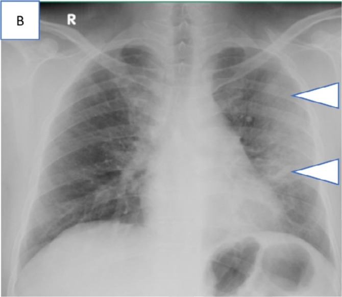 Series of chest radiograph in patients with COVID-19 pneumonia who were transferred out of community care facility, Singapore Expo, to acute hospitals in view of respiratory symptoms or deranged vitals and subsequently required supplemental oxygen. Admission chest radiographs, A, in a 41-year-old man on day 3 of illness with a large left pleural effusion and adjacent consolidation (arrowhead) treated for concomitant pleural tuberculosis, B, in a 40-year-old man on day 4 of illness with consolidation across the left mid and upper zones (arrowheads), and, C, in a 42-year-old man on day 4 of illness with patchy GGOs in the peripheral aspects of both the mid zone and the left lower zone (arrowheads).