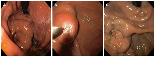 Efficacy and safety of endoscopic prophylactic treatment with undiluted ...