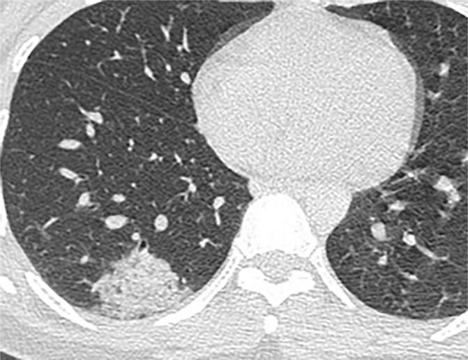 Chest CT findings in adult patients with COVID-19 on transaxial images. (a) Woman, 36 years old, 1 day after symptom onset. Subpleural ground-glass opacity in left lower lobe. (b) Man, 54 years old, 4 days after symptom onset. Subpleural ground-glass opacity in left lower lobe with inter- and intralobular septal thickening (crazy paving) and a ground-glass nodule in the right lower lobe (arrow). (c) Man, 28 years old, 3 days after symptom onset. Subpleural ground-glass opacity in the left lower lobe with central consolidation. (d) Woman, 49 years old, 7 days after symptom onset. Pure consolidation in right lower lobe. (e) Man, 42 years old, 6 days after symptom onset. Bilateral multifocal pure ground-glass opacities. (f) Man, 62 years old, 14 days after symptom onset, bilateral foci of consolidation in both lower lobes, with early linear opacities in a perilobular pattern (arrows).