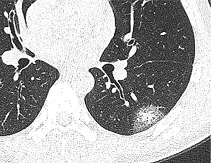 Chest CT findings in adult patients with COVID-19 on transaxial images. (a) Woman, 36 years old, 1 day after symptom onset. Subpleural ground-glass opacity in left lower lobe. (b) Man, 54 years old, 4 days after symptom onset. Subpleural ground-glass opacity in left lower lobe with inter- and intralobular septal thickening (crazy paving) and a ground-glass nodule in the right lower lobe (arrow). (c) Man, 28 years old, 3 days after symptom onset. Subpleural ground-glass opacity in the left lower lobe with central consolidation. (d) Woman, 49 years old, 7 days after symptom onset. Pure consolidation in right lower lobe. (e) Man, 42 years old, 6 days after symptom onset. Bilateral multifocal pure ground-glass opacities. (f) Man, 62 years old, 14 days after symptom onset, bilateral foci of consolidation in both lower lobes, with early linear opacities in a perilobular pattern (arrows).