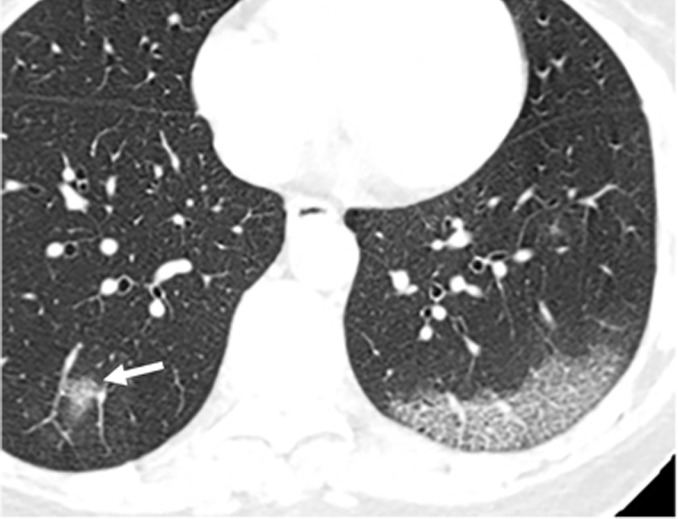 Chest CT findings in adult patients with COVID-19 on transaxial images. (a) Woman, 36 years old, 1 day after symptom onset. Subpleural ground-glass opacity in left lower lobe. (b) Man, 54 years old, 4 days after symptom onset. Subpleural ground-glass opacity in left lower lobe with inter- and intralobular septal thickening (crazy paving) and a ground-glass nodule in the right lower lobe (arrow). (c) Man, 28 years old, 3 days after symptom onset. Subpleural ground-glass opacity in the left lower lobe with central consolidation. (d) Woman, 49 years old, 7 days after symptom onset. Pure consolidation in right lower lobe. (e) Man, 42 years old, 6 days after symptom onset. Bilateral multifocal pure ground-glass opacities. (f) Man, 62 years old, 14 days after symptom onset, bilateral foci of consolidation in both lower lobes, with early linear opacities in a perilobular pattern (arrows).