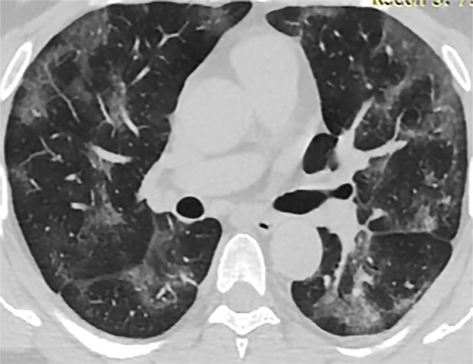 Chest CT findings in adult patients with COVID-19 on transaxial images. (a) Woman, 36 years old, 1 day after symptom onset. Subpleural ground-glass opacity in left lower lobe. (b) Man, 54 years old, 4 days after symptom onset. Subpleural ground-glass opacity in left lower lobe with inter- and intralobular septal thickening (crazy paving) and a ground-glass nodule in the right lower lobe (arrow). (c) Man, 28 years old, 3 days after symptom onset. Subpleural ground-glass opacity in the left lower lobe with central consolidation. (d) Woman, 49 years old, 7 days after symptom onset. Pure consolidation in right lower lobe. (e) Man, 42 years old, 6 days after symptom onset. Bilateral multifocal pure ground-glass opacities. (f) Man, 62 years old, 14 days after symptom onset, bilateral foci of consolidation in both lower lobes, with early linear opacities in a perilobular pattern (arrows).