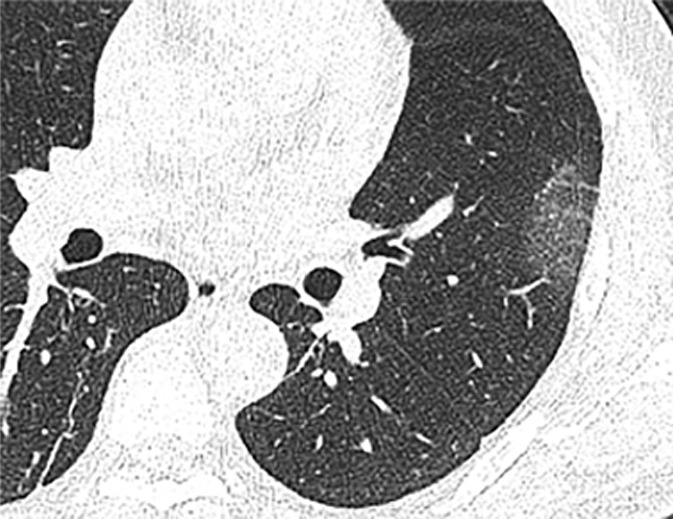 Chest CT findings in adult patients with COVID-19 on transaxial images. (a) Woman, 36 years old, 1 day after symptom onset. Subpleural ground-glass opacity in left lower lobe. (b) Man, 54 years old, 4 days after symptom onset. Subpleural ground-glass opacity in left lower lobe with inter- and intralobular septal thickening (crazy paving) and a ground-glass nodule in the right lower lobe (arrow). (c) Man, 28 years old, 3 days after symptom onset. Subpleural ground-glass opacity in the left lower lobe with central consolidation. (d) Woman, 49 years old, 7 days after symptom onset. Pure consolidation in right lower lobe. (e) Man, 42 years old, 6 days after symptom onset. Bilateral multifocal pure ground-glass opacities. (f) Man, 62 years old, 14 days after symptom onset, bilateral foci of consolidation in both lower lobes, with early linear opacities in a perilobular pattern (arrows).