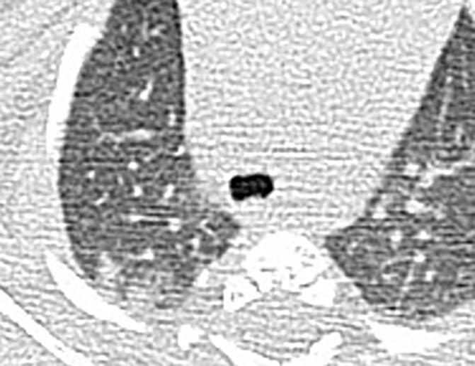 Chest CT findings of pediatric patients with COVID-19 on transaxial images. (a) Male patient, 2 months old, 2 days after symptom onset. Patchy ground-glass opacities (GGOs) in the right lower lobe. (b) Female patient, 4 years old, 4 days after symptom onset, two subpleural nodules in the right lower lobe. (c) Male patient, 8 months old, 6 days after symptom onset. Bronchial wall thickening and peribronchial GGOs and consolidation are noted in the left lower lobe.