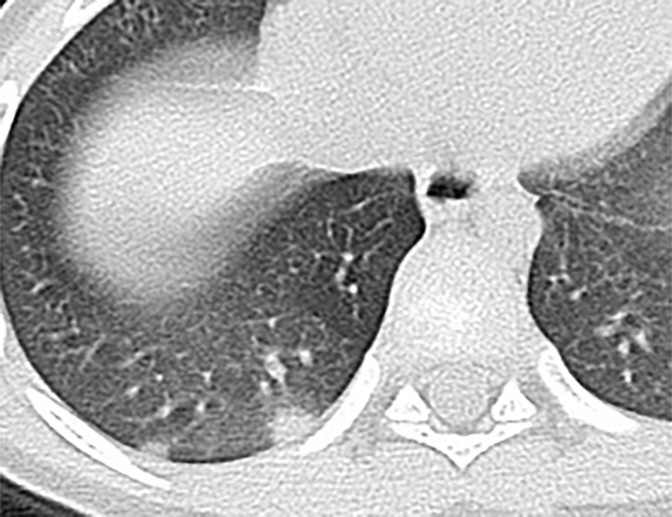 Chest CT findings of pediatric patients with COVID-19 on transaxial images. (a) Male patient, 2 months old, 2 days after symptom onset. Patchy ground-glass opacities (GGOs) in the right lower lobe. (b) Female patient, 4 years old, 4 days after symptom onset, two subpleural nodules in the right lower lobe. (c) Male patient, 8 months old, 6 days after symptom onset. Bronchial wall thickening and peribronchial GGOs and consolidation are noted in the left lower lobe.