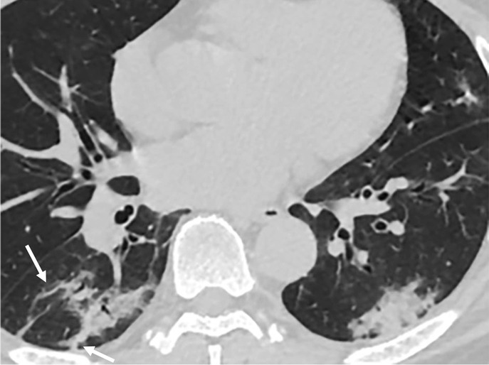 Chest CT findings in adult patients with COVID-19 on transaxial images. (a) Woman, 36 years old, 1 day after symptom onset. Subpleural ground-glass opacity in left lower lobe. (b) Man, 54 years old, 4 days after symptom onset. Subpleural ground-glass opacity in left lower lobe with inter- and intralobular septal thickening (crazy paving) and a ground-glass nodule in the right lower lobe (arrow). (c) Man, 28 years old, 3 days after symptom onset. Subpleural ground-glass opacity in the left lower lobe with central consolidation. (d) Woman, 49 years old, 7 days after symptom onset. Pure consolidation in right lower lobe. (e) Man, 42 years old, 6 days after symptom onset. Bilateral multifocal pure ground-glass opacities. (f) Man, 62 years old, 14 days after symptom onset, bilateral foci of consolidation in both lower lobes, with early linear opacities in a perilobular pattern (arrows).