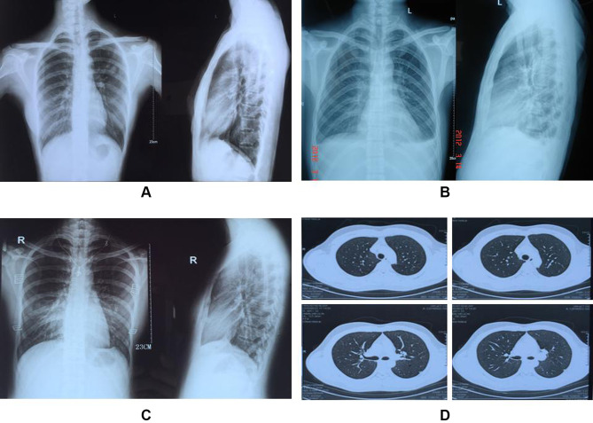 The Intrapleural Bridge Connection is One of the Reasons for Unknown ...