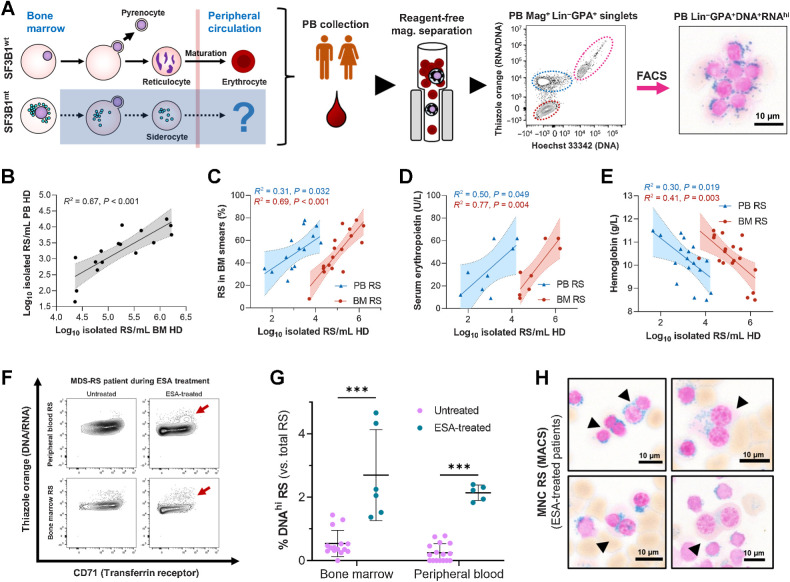 Figure 3. Peripherally circulating RS are common and clinically relevant in MDS-RS. A, Isolation steps from the PB HD fraction of patients with MDS-RS through reagent-free magnetic separation and representative flow cytometry diagram, where RS are identifiable and validated as present through morphological analysis. B, Correlation of RS abundances isolated from matched BM and PB samples (leftmost subpanel, n = 16). C–E, Correlation of log10-converted isolated RS numbers obtained from anemic (Hb < 12.0 g/dL) patients with MDS-RS with BM RS percentages from clinical BM smears (nPB = 15, nBM = 17; C), serum erythropoietin levels (untreated patients only, nPB = 8, nBM = 8; D), and hemoglobin levels (nPB = 18, nBM = 19; E). F, Flow cytometry example of BM and PB RS with increased DNA content comparing two visits of the same patient to the clinic, before and after ESA treatment. A cell population of increased DNA content is highlighted with dark red arrows. G, Mean (SD) frequency of RS with elevated DNA content, separated by EPO treatment status and cell fraction of origin. Arrows indicate binucleate RS identified during morphological analysis of EPO-treated and RS-enriched samples. Scale bars, 10 μm. H, Morphologic visualization of binucleated RS in ESA-treated, RS-enriched samples. Scale bars, 10 μm. ***, P < 0.001.