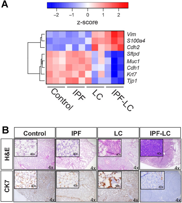 Figure 6. Pronounced EMT in IPF-LC. RNA-seq data as described in Fig. 4 was used to query genes important in EMT. A, Heat map of log10 normalized counts (z-score) for selected mesenchymal and epithelial marker genes in all groups: control, IPF, LC, IPF-LC. B, Representative images (4x; 40x inset) of lung section in each group stained with H&E (top) and Cytokeratin 7 (bottom).