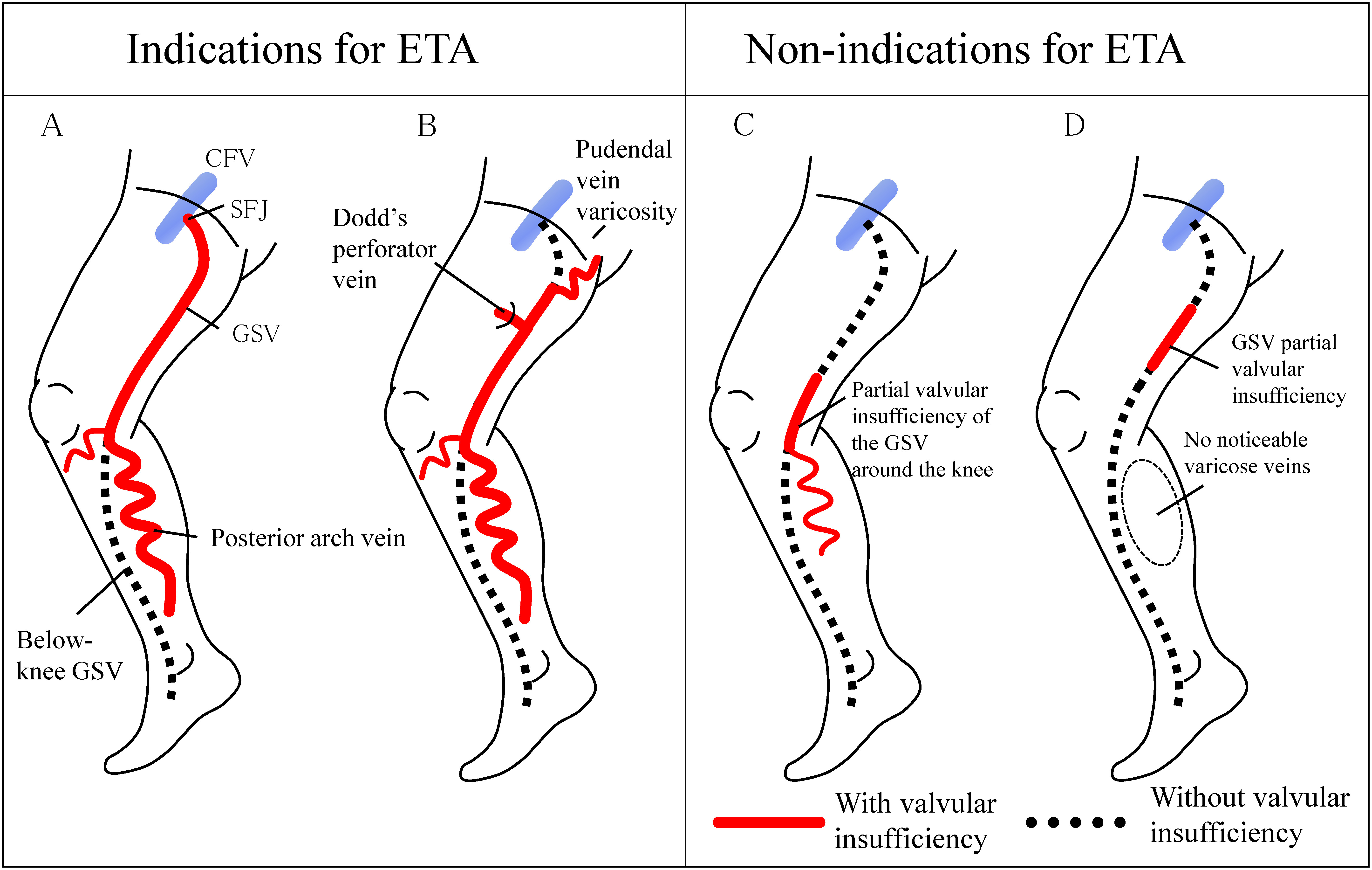 Fig. 1 Valvular insufficiency of the saphenous vein and indications for endovenous thermal ablation (ETA).