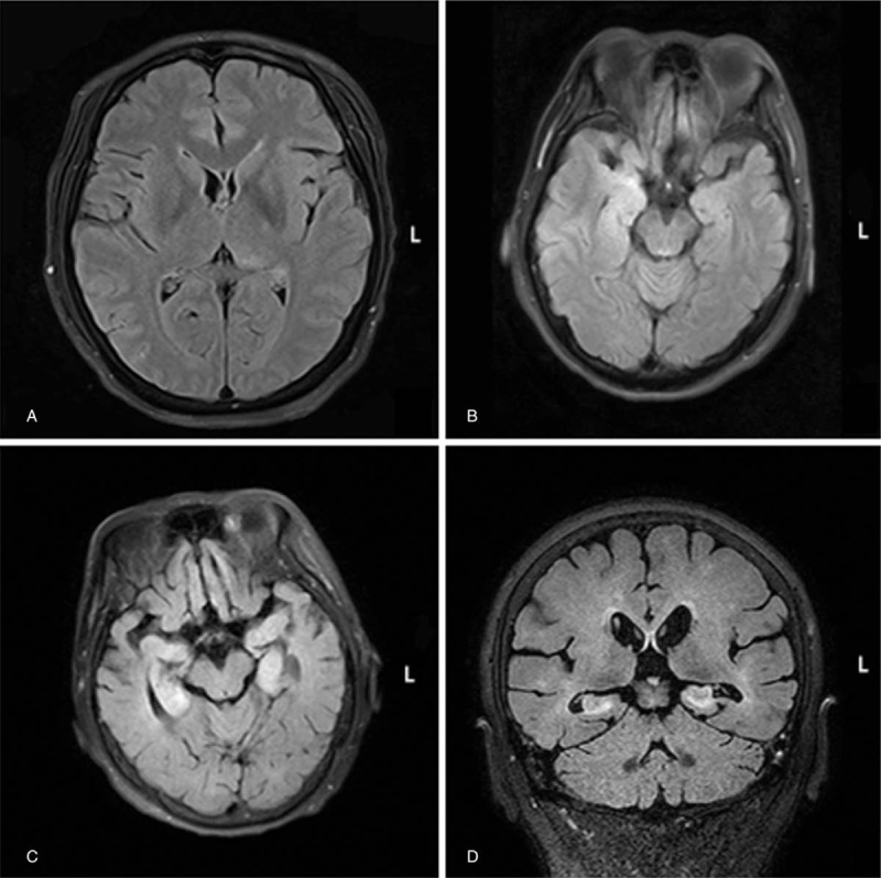 Various clinical features of patients with anti-Hu associated ...