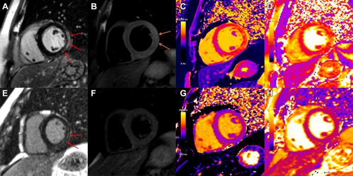 Case example in a 31-year-old man with viral myocarditis. Initial cardiac MRI performed at 3 T within 1 week of symptom onset demonstrates (A) subepicardial to nearly transmural late gadolinium enhancement (LGE) at the basal to mid anterior lateral, inferior lateral, and inferior wall (red arrows) with (B) corresponding high T2 signal, in keeping with edema (orange arrows), (C) high regional native T1 (1480 msec), and (D) high regional native T2 (56 msec) on short-axis images. Images from follow-up cardiac MRI performed at 1.5 T 5 months later demonstrate contraction of subepicardial LGE at the basal to mid inferior lateral and inferior wall (E, red arrows) with (G) corresponding high regional native T1 suggestive of fibrosis (1305 msec) and (F) resolution of edema with no corresponding high T2 signal and (H) normalization of T2 mapping values (46 msec).