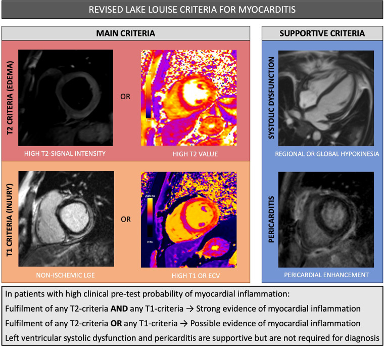 Summary of revised Lake Louise criteria for myocarditis. ECV =extracellular volume, LGE = late gadolinium enhancement.