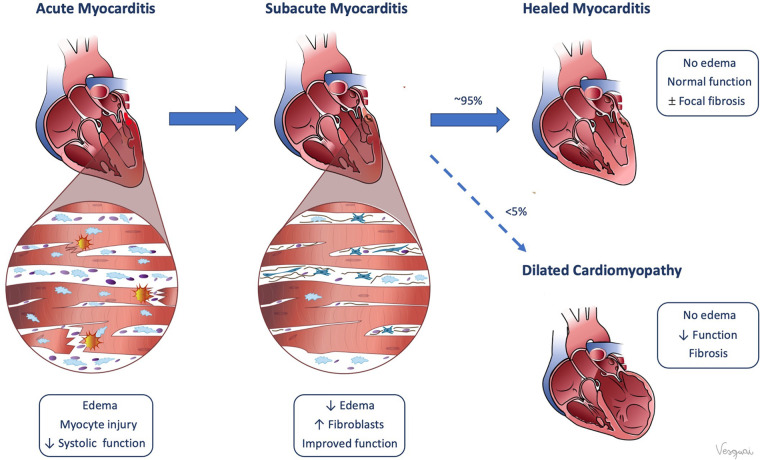 Pathophysiology of myocarditis. (Reprinted, with permission, from Valentina Sanchez Tijmes).