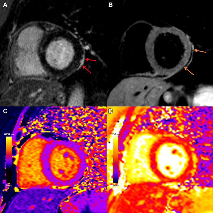 Myocardial injury and pericarditis following COVID-19. Case example in a 57-year-old woman with COVID-19 who presented with chest pain after having elevated troponin levels. Cardiac MRI performed at 1.5 T 4 weeks after polymerase chain reaction–confirmed diagnosis of SARS-CoV-2 infection demonstrates subepicardial late gadolinium enhancement at the (A) basal inferior lateral wall with adjacent pericardial enhancement (red arrows), with (B) corresponding high T2 signal (orange arrows), and (C) high regional native T1 (1236 msec) and (D) high regional native T2 (67 msec) on short-axis images, in keeping with myopericarditis.