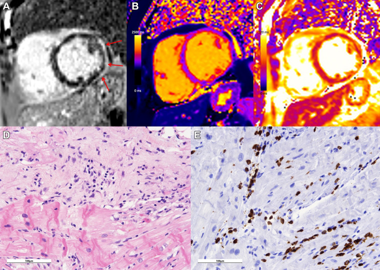 Case example in a 68-year-old woman with lymphocytic myocarditis related to immune checkpoint inhibitor therapy. Cardiac MRI performed at 1.5 T demonstrates extensive subepicardial late gadolinium enhancement at (A) the basal to mid anterior, anterior lateral, inferior lateral, and inferior wall (red arrows) with (B) corresponding high regional native T1 (1280 msec) and (C) high regional T2 (69 msec) on short-axis images, in keeping with myocardial edema and damage. (D) Histologic images from endomyocardial biopsy demonstrate inflammation, including an active (dense inflammation) and healing (looser mixed inflammation, expanded matrix) component, with myocyte damage evident as myocytolytic change, vacuolization, and atrophy on hematoxylin-eosin stain. (E) At CD3 immunohistochemistry, a substantial portion of the inflammatory population was CD3 positive, consistent with a T-cell–mediated (lymphocytic) active myocarditis. Both histologic images were acquired with a Leica DM2500 microscope with a 20× objective and an OMAX A35180U3 camera. Images were acquired with ToupView software; no further adjustments were made. Scale bars (100 µm) are as shown.