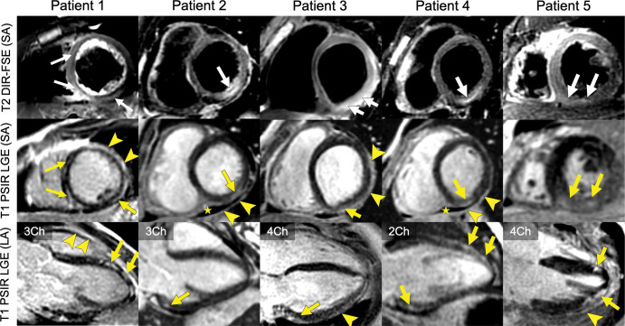 Cardiac MR images in five patients diagnosed with acute myocarditis 3–5 days after a second dose of mRNA vaccine. Yellow arrows depict myocardial late gadolinium enhancement in a nonischemic pattern, white arrows depict corresponding T2 signal abnormalities, arrowheads depict pericardial enhancement, and stars depict pericardial effusion. Patient 1 (male, age 21 years) 3 days after vaccination with BNT162b2. Patient 2 (female, age 32 years) 4 days after vaccination with BNT162b2. Patient 3 (male, age 17 years) 5 days after vaccination with BNT162b2. Patient 4 (male, age 18 years) 5 days after vaccination with mRNA-1273. Patient 5 (male, age 38 years) 5 days after vaccination with mRNA-1273. 4Ch = four-chamber view, LA = long axis, PSIR LGE = phase-sensitive inversion recovery late gadolinium enhanced imaging, SA = short axis, T2w DIR-FSE = T2-weighted double inversion recovery fast spin echo, 3Ch = three-chamber view, 2Ch = two-chamber view.