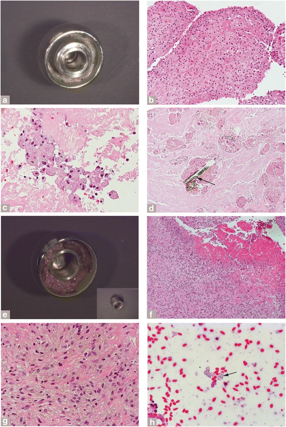 Histopathological Characterization Of Corrosion Product Associated 