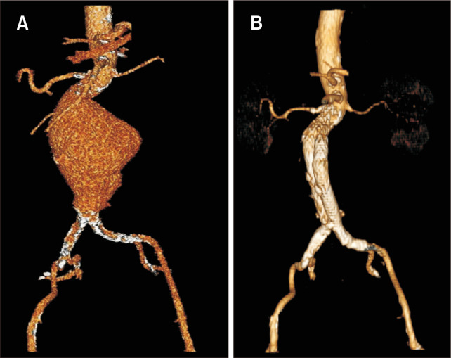 Current Clinical Knowledge on GORE EXCLUDER Conformable Abdominal ...