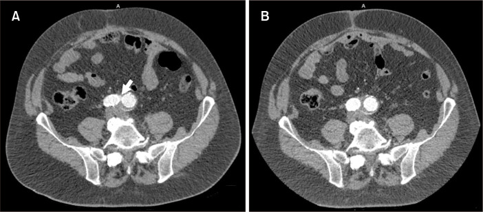 Current Clinical Knowledge on GORE EXCLUDER Conformable Abdominal ...