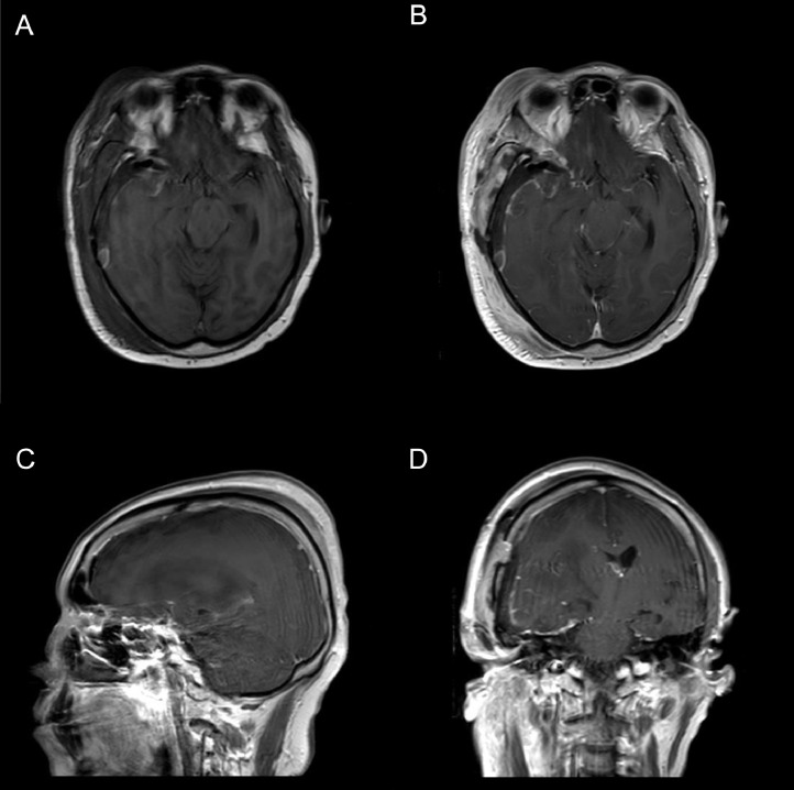 A rare case of breast carcinoma metastasis into a meningioma in a 64 ...