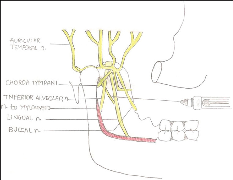 Comparison of Vazirani-Akinosi and Kurt-Thoma technique for mandibular ...