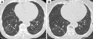 Paired axial unenhanced CT scans in an 83-year-old woman at (A) 3
months and (B) 1 year after hospital discharge for COVID-19. Images show
significant (albeit incomplete) and progressive resolution of ground-glass
opacification and band opacities in the lower lobes at 1-year
follow-up.