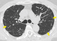 Axial unenhanced CT scan at the level of the carina in a 56-year-old
man 3 months after discharge for COVID-19. Image shows multiple linear and
curvilinear bands (yellow arrows) and more limited, subtle ground-glass
opacification. There was no evidence of traction bronchiectasis. Note the
normally tapering airway (white arrows) in the anterior segment of the left
upper lobe.