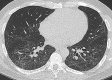 Axial unenhanced CT scan in a 48-year-old man 3 months after hospital
discharge for COVID-19. Image shows predominant ground-glass opacities and a
few delicate band opacities, principally in the lower lobes. There was no
traction bronchiectasis or reticulation on any image section. (Note that the
short segment of airway captured in longitudinal section in the right lower
lobe was nondilated on sequential volumetric images sections.)