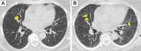 Paired axial unenhanced CT scans in a 59-year-old man at (A) 3 months
and (B) 1 year after hospital discharge for COVID-19. Images show widespread
residual bilateral ground-glass opacification, a few band opacities, and,
importantly, evidence of traction bronchiectasis in the middle and left
lower lobes (arrow in A) at 3 months. There is a reduction in the extent of
ground-glass opacification and bands but with persistent traction
brochiectasis (arrows in B) at 1-year follow-up.