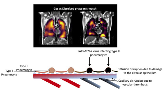 Schematic drawing of the processes leading to gas-dissolved phase mismatch post-COVID.