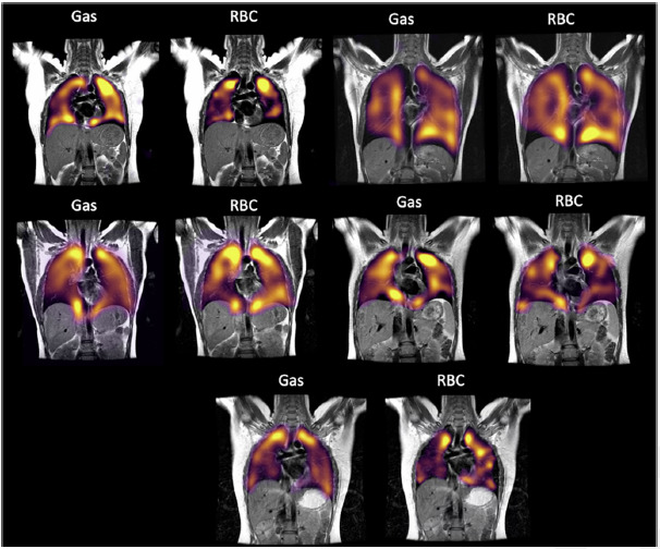 A montage of all volunteers scanned in this study showing Gas and RBC phase imaging.