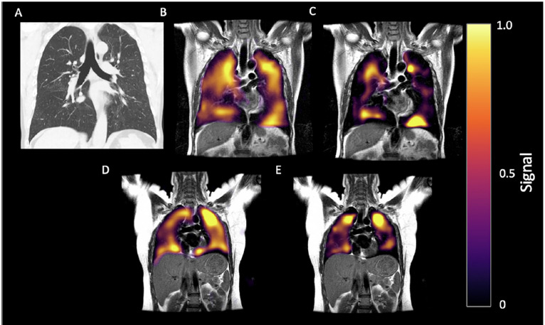 60-year-old man with history of post-COVID breathlessness, shown 172 days after discharge. (A) CT, (B) Ventilation and (C) RBC phase imaging. (D) Gas and (E) RBC phase imaging for a healthy control. 129Xe MRI images shown in the coronal view for both, with disrupted RBC in the patient.